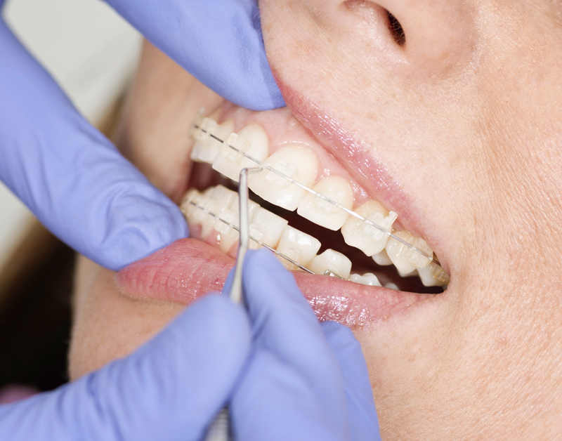 orthodontist_beugel_800.jpg orthodontist_beugel_800.jpg
