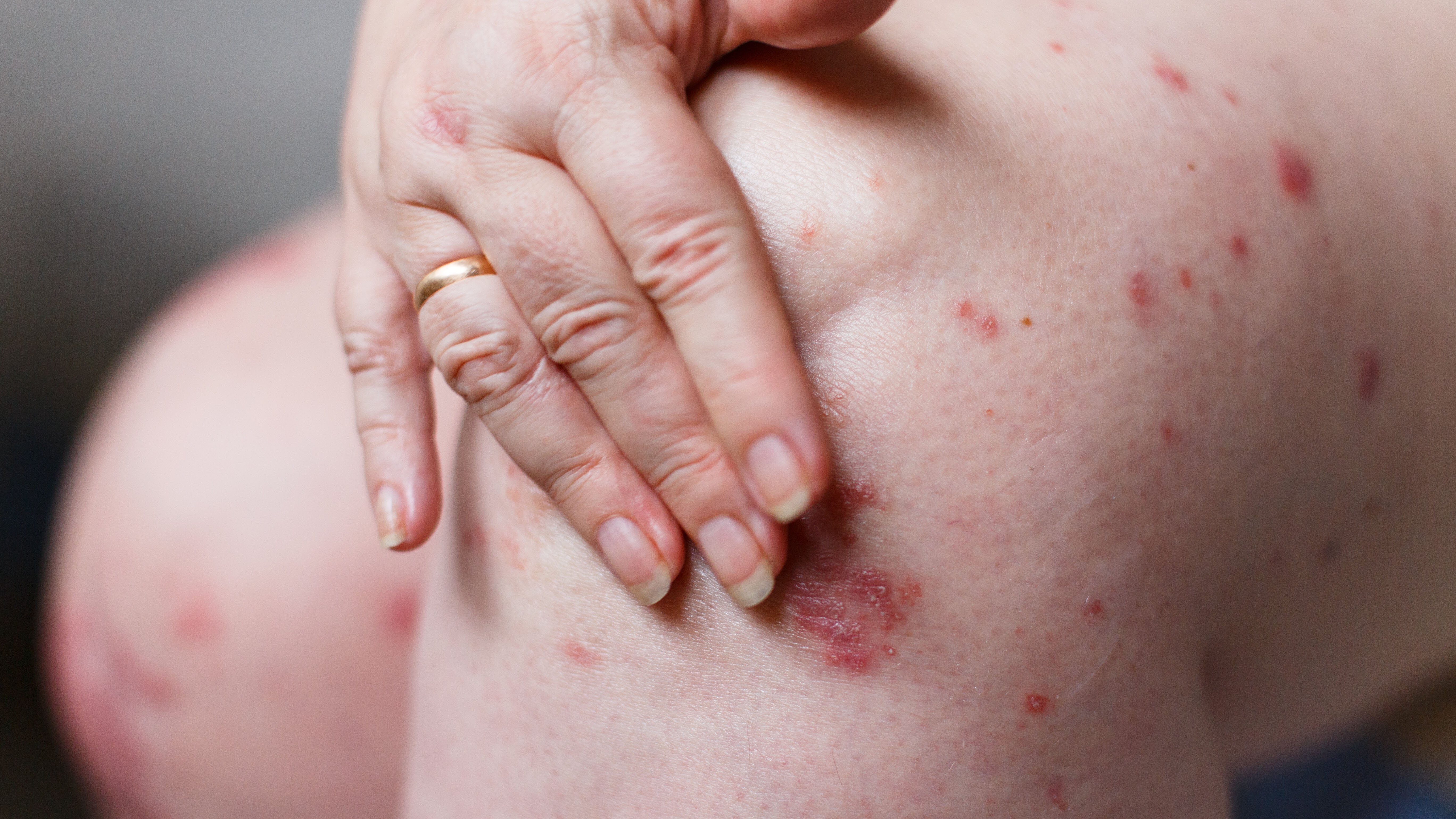 psoriasis .jpg psoriasis .jpg