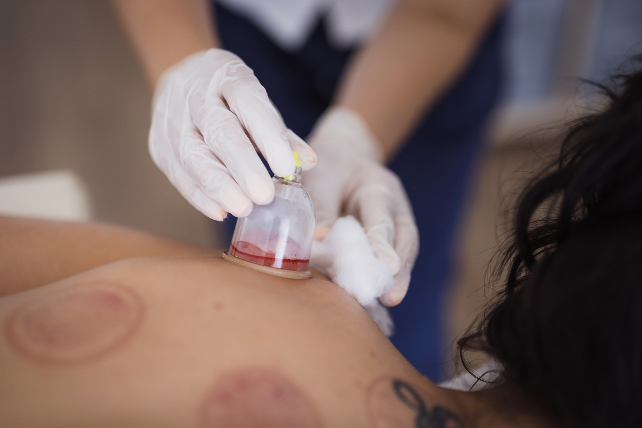 Wet Cupping