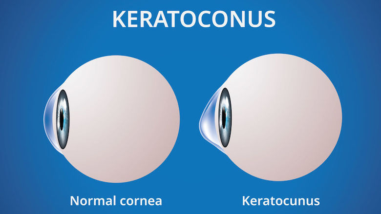 20200703 keratoconus.jpg 20200703 keratoconus.jpg