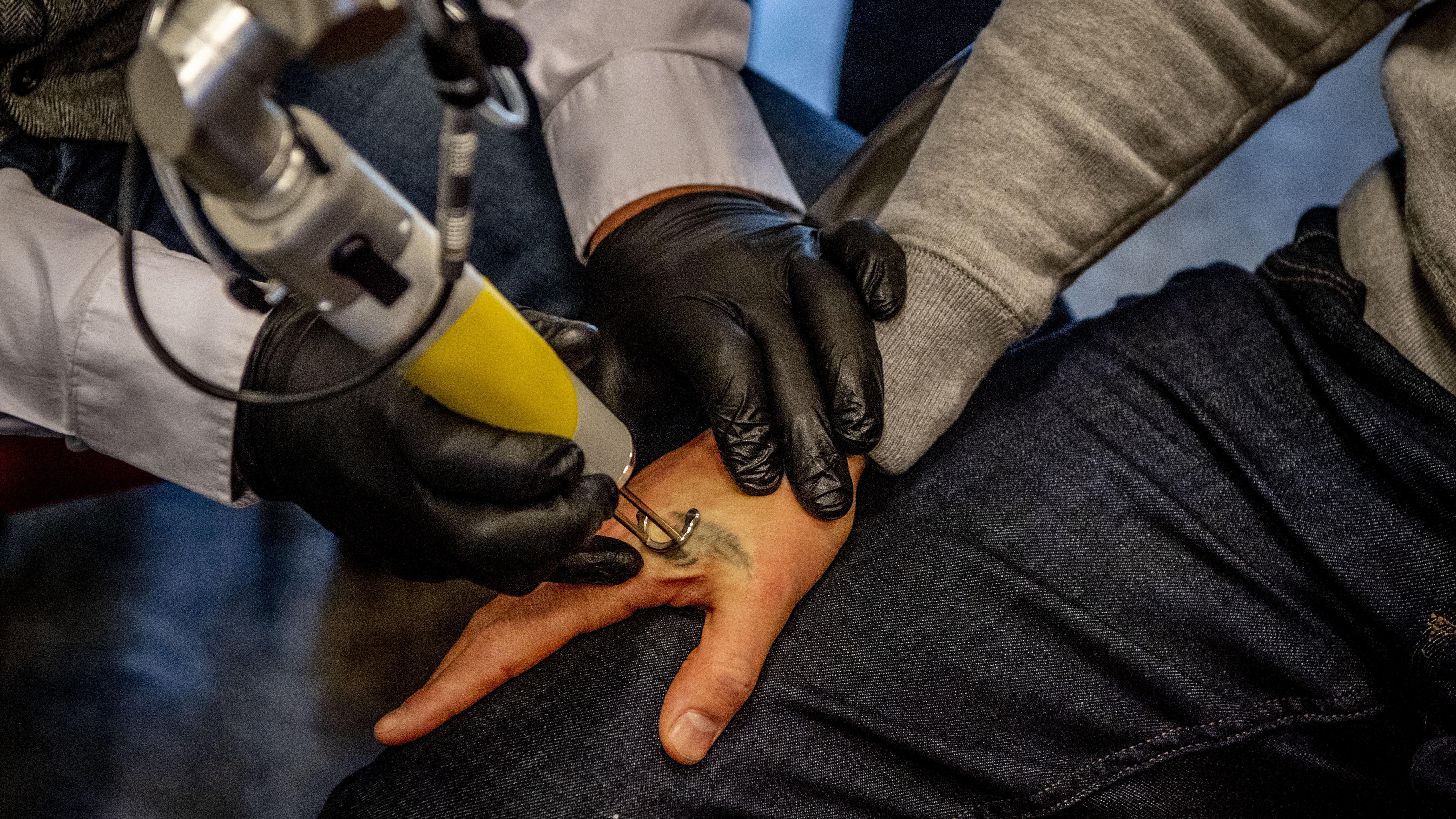 Tattoo Laseren Tattoo Laseren