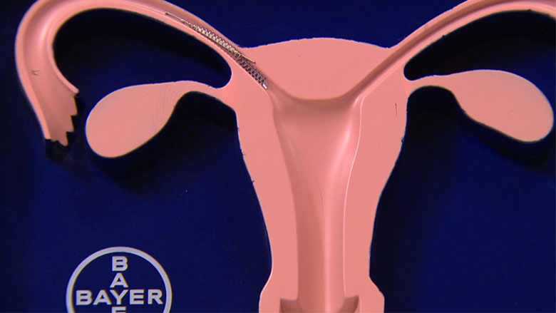 essure-thumb.jpg essure-thumb.jpg