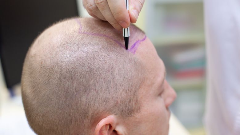 haartransplantatie site.jpg haartransplantatie site.jpg