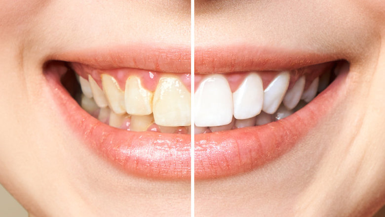 22-01-17-tanden-wit-gebit-bleken-whitening-tandpasta.jpg 22-01-17-tanden-wit-gebit-bleken-whitening-tandpasta.jpg