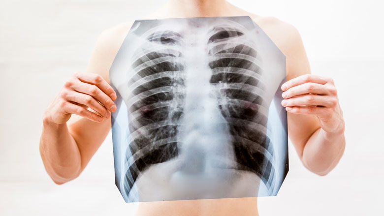 tuberculose-19032019.jpg tuberculose-19032019.jpg